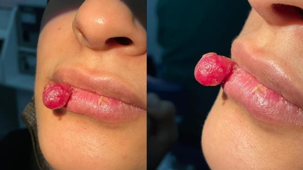 Tidak Sengaja Gigit Bibir Saat Makan! Wanita Ini Alami Daging Tumbuh Sebesar 2 CM, Ini Penyebabnya